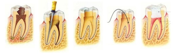 Imagen de Diente endodoncia